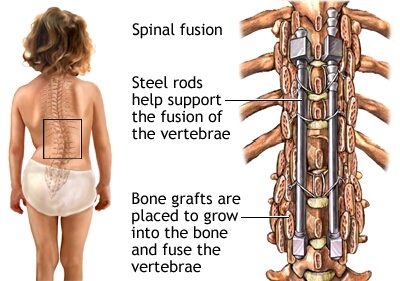 Scoliosis | Why I Chose NOT To Have A Spinal Fusion